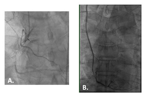 Ismics Robotic Totally Endoscopic Beating Heart Bypass To The Right