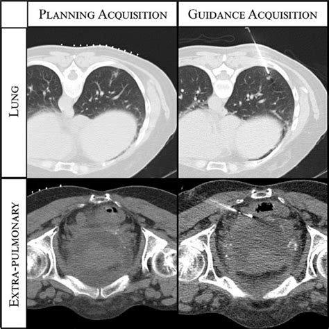 Lung nodule biopsy with low dose CT guidance protocol. Single images ...