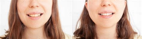 person smiles, shows teeth, yellow plaque, crooked teeth, malocclusion