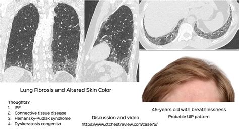 Case Lung Fibrosis And Altered Skin Color