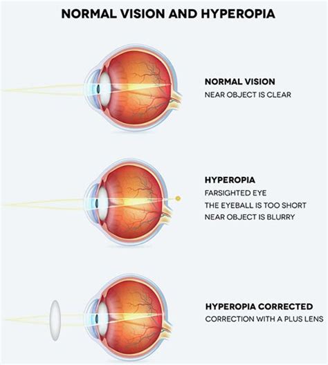 Lazy Eye Amblyopia Treatment · Eye Specialist · Nyc Ophthalmologist