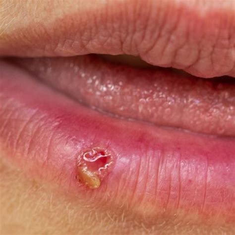 Lippenherpes Behandlung Diagnose Direkt Vom Online Hautarzt