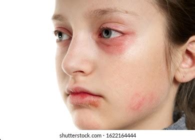 Allergic Reaction Skin Rash Close View Stock Photo 1622164444 ...