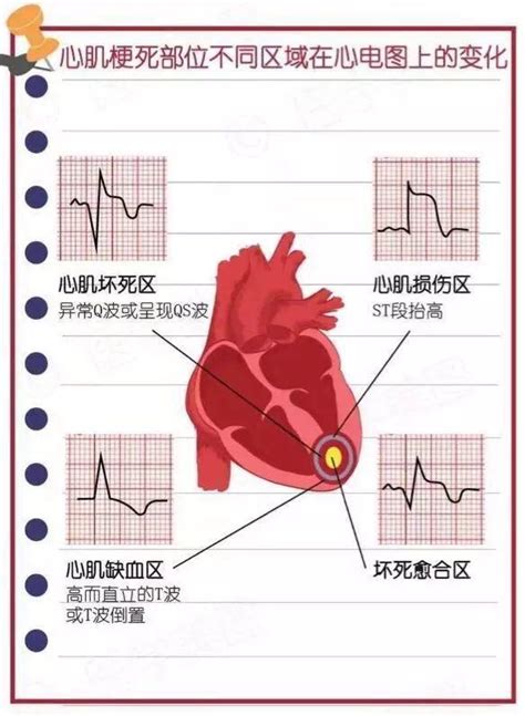 心肌梗死的心电图及临床表现 知乎