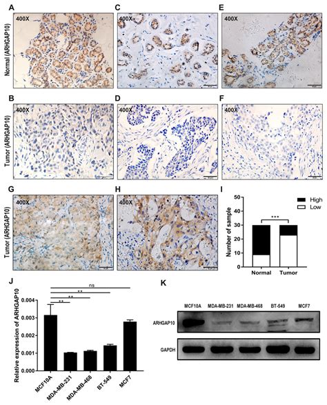 Downregulated Expression Of Arhgap Correlates With Advanced Stage And