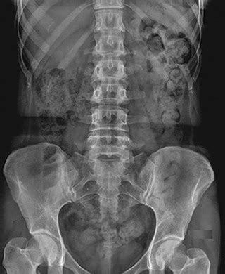 Plain Radiography Of The Abdomen Radiology Key