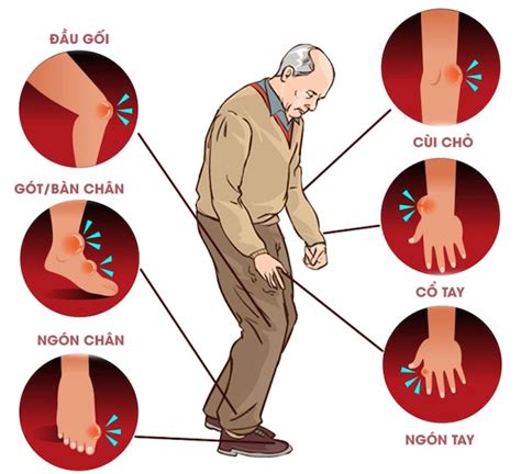 Bệnh Gout Mạn Tính Là Gì Nguyên Nhân Triệu Chứng Cách điều Trị