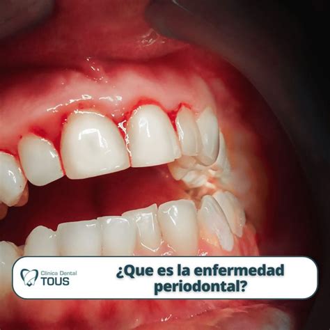 La enfermedad periodontal que es qué la causa y cómo prevenirla