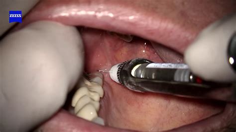 Inferior Alveolar Injection With Dental Operating Microscope Youtube