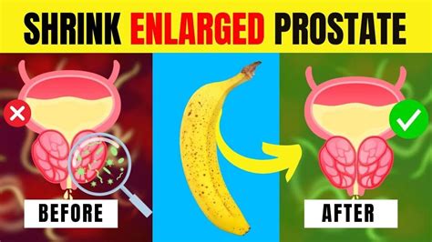 How To Shrink Enlarged Prostate Naturally Artofit