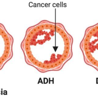 Stages Of Breast Cancer Development Tumour Cell Initiation And