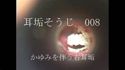 耳垢そうじ痒みを伴う鼓膜に付着した耳垢008 Youtube