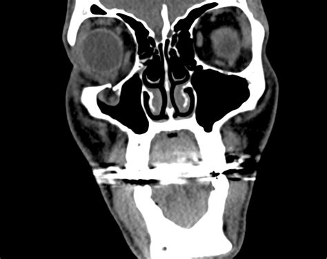 Differential Diagnosis Of Diplopia Applied