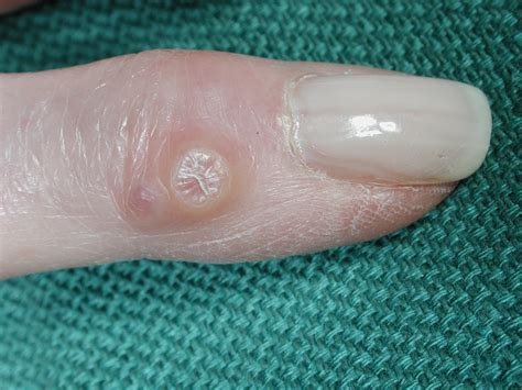 Digital Mucous Cyst Ganglion On The Finger Pictures Treatment