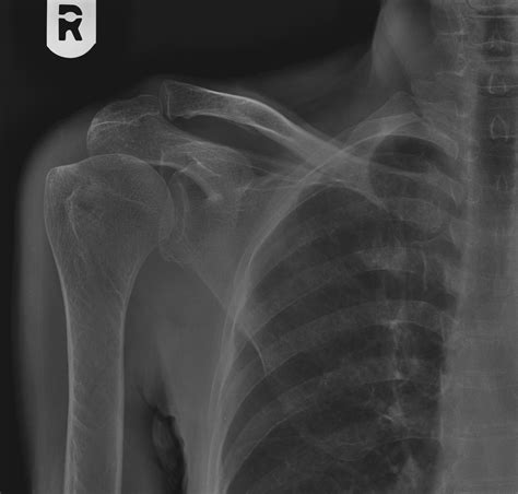 Lesser Tuberosity Fracture