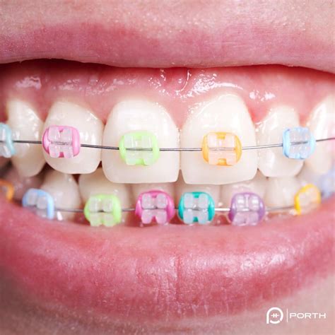 Braces Colors | How to pick the right color for your braces