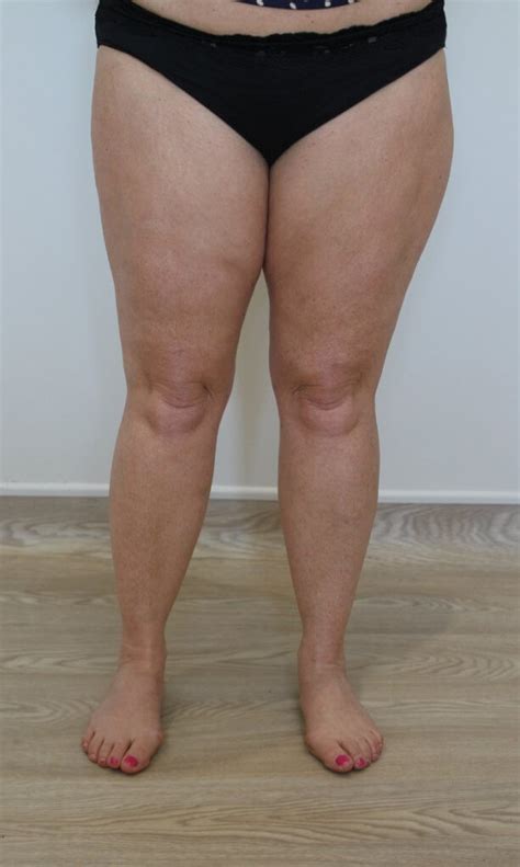 Thigh Liposuction After Ap View The Karri Clinic