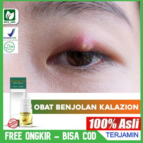 Jual Obat Kalazion Sakit Mata Bintitan Menahun Benjolan Kelopak