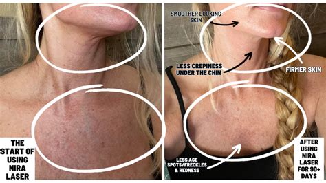 My NIRA Pro Laser Results Before And After Pictures 25 Off Code