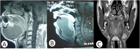 Dermoid Cysts Of The Floor Of Mouth A Review Medcrave Online