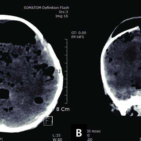 Diffuse Pneumocephalus With Brain Herniation Through The Posterior