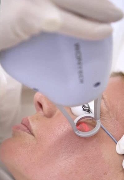 Laser Lavieen Para Olheiras Clinicabse