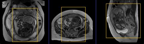 Fetal abdominal MRI | Fetal abdominal MRI protocol and planning