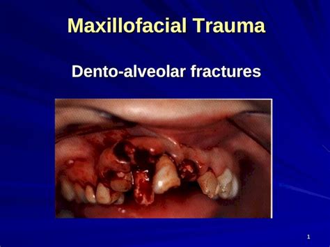 Ppt Maxillofacial Trauma Dento Alveolar Fractures Definition Are