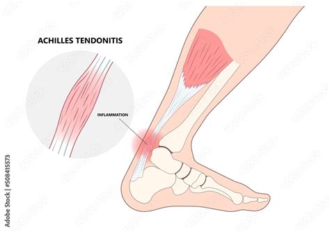 Inflammation Of Achilles Tendon Injury Feet Calf Test Range Of Motion Slight Ache Problem Limb