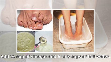 How To Get Rid Of Stinky Feet Forever With Baking Soda Vinegar And