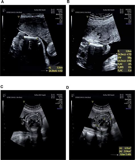 Frontiers Prenatal Diagnosis Of Recurrent Moderate Skeletal