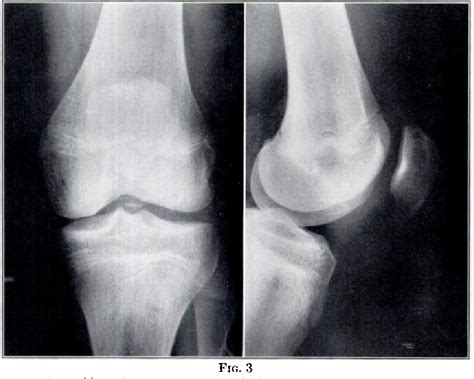 Figure From Osteochondral Fracture In The Knee Joint Associated