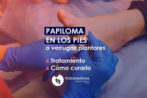 Papiloma En Los Pies O Verrugas Plantares Tratamiento Y C Mo Curarlo