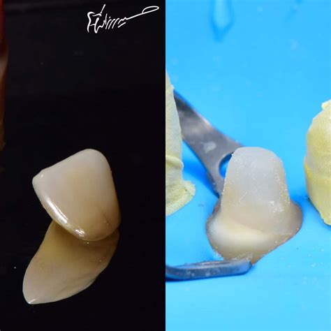 Using “Ribbond” to save destructive lateral incisor ! - MyZerodonto