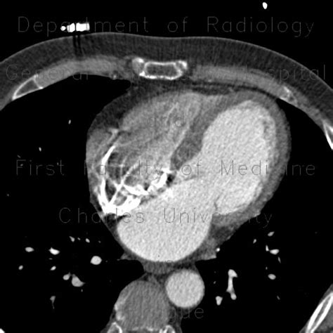 Radiology case: Hypodense subendocardial layer, myocardial infarction