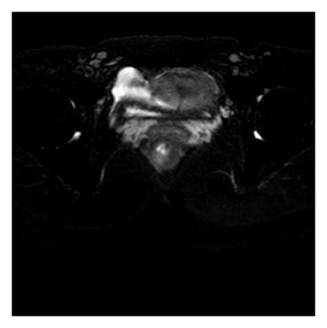 A Rectovaginal Fistula Before Treatment Red Arrow Of One Case In