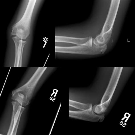 Medial Epicondyle Fracture