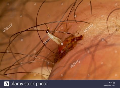 Human Botfly Part Removed From Host Person Dermatobia Hominis Amazonian