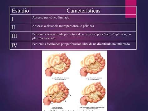 Enfermedad Diverticular Ppt Descarga Gratuita