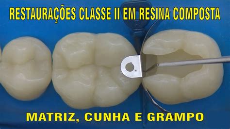 Restaura O Classe Ii Em Resina Composta Parte Youtube