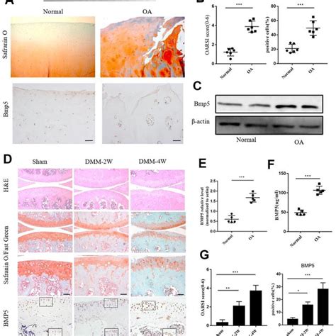 Bmp5 Is Overexpressed In Knee Articular Cartilage Tissues Of Oa