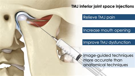 Temporomandibular Joint Injection Amara Pain Spine Management