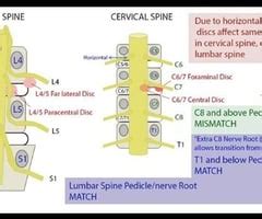 Cervical Radiculopathy Flashcards Quizlet