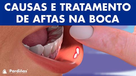 AFTA NA BOCA Causas E Tratamento De Aftas YouTube