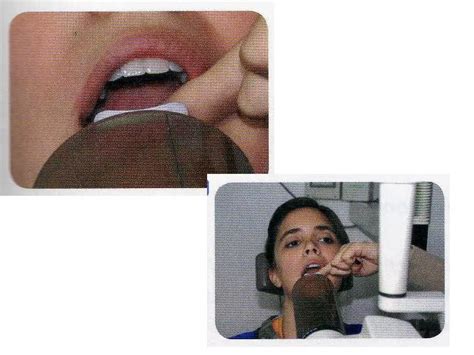 Tecnica De Bisectriz 6