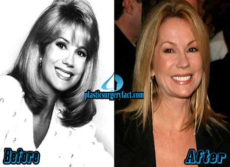 Kathie Lee Gifford Plastic Surgery Before and After