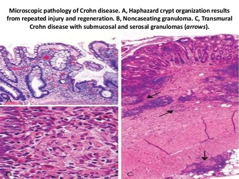 Crohns Disease Signs Symptoms Morphology