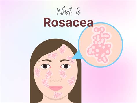 Understanding Rosacea Causes Symptoms And Effective Treatments