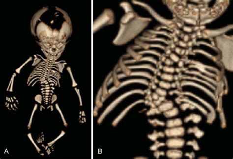 Autopsy Imaging A Postmortem Computed Tomography Showed Multiple