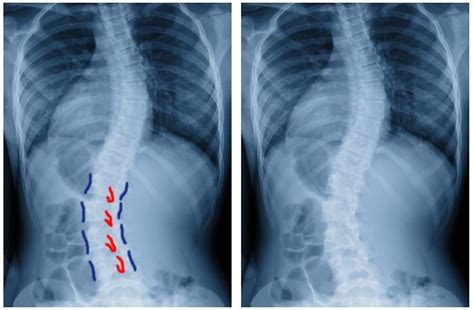 Escoliosis Causas Síntomas Y Tratamientos Ar